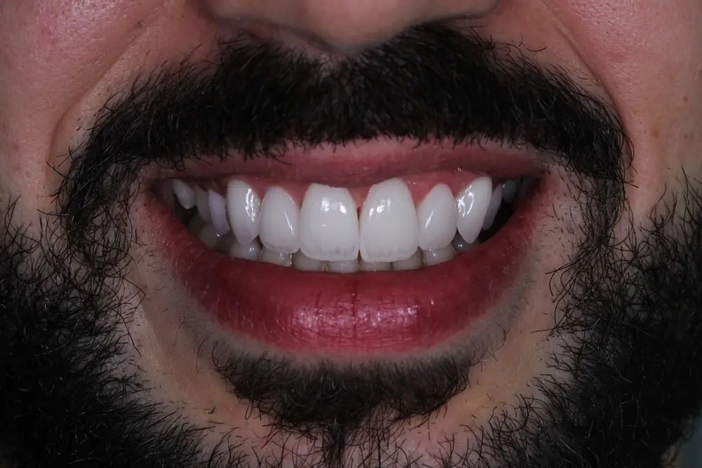 Realinhamento e Clareamento com Facetas de Porcelana em Recife — depois (Dra. Natália Pompílio)