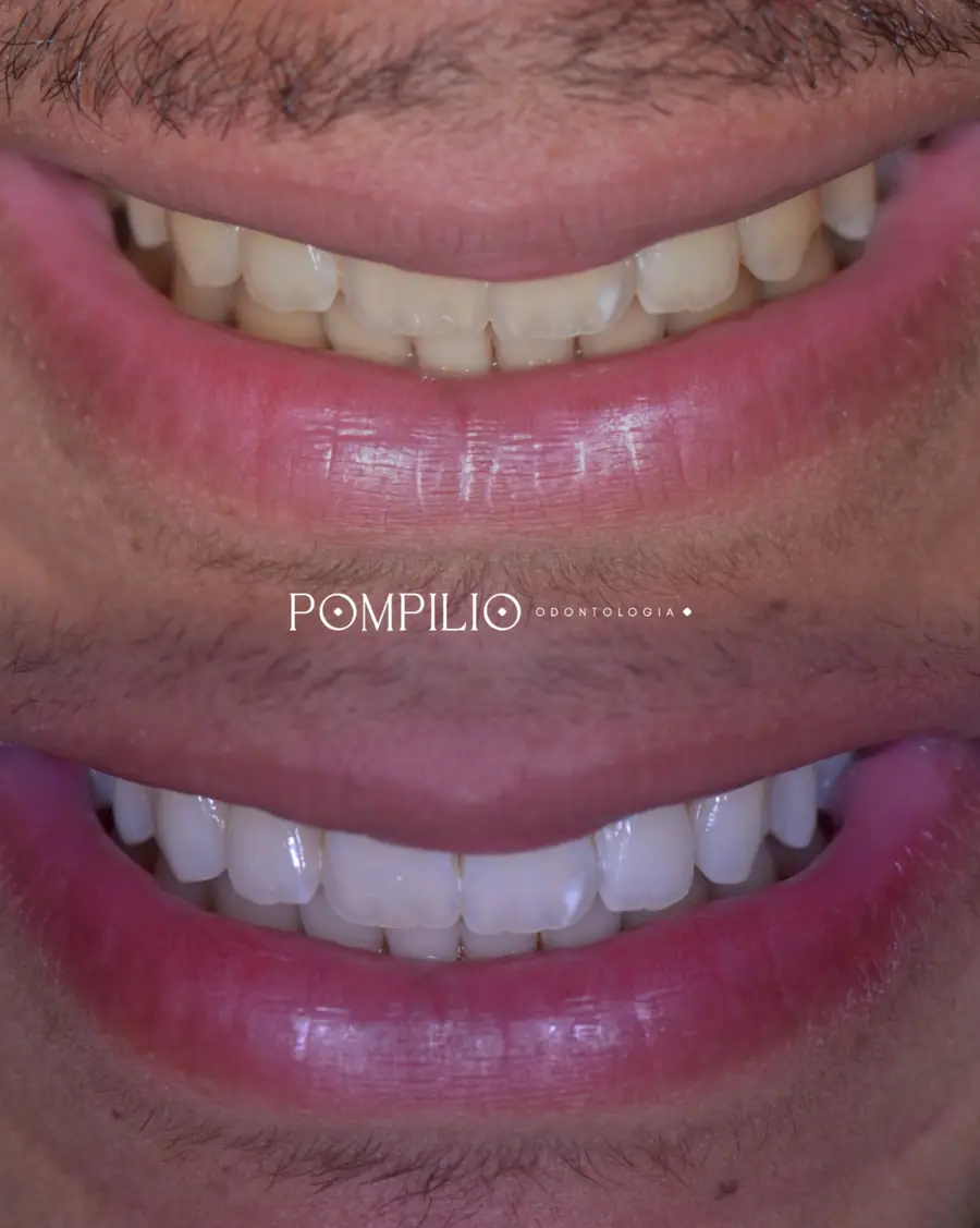 Clareamento dental em Recife — brilho seguro e profissional