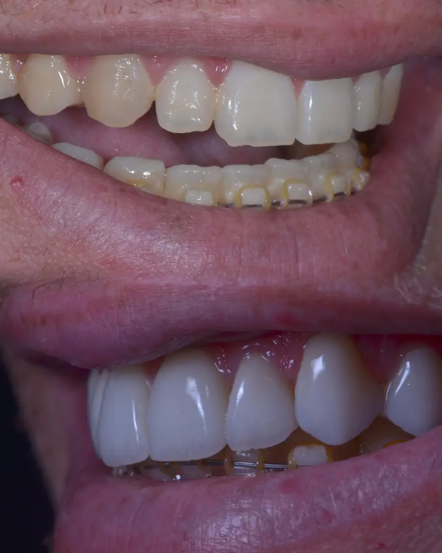 Facetas de porcelana em Recife — sorriso natural e elegante