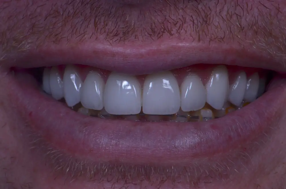 Harmonização do Sorriso com Facetas em Resina + Contorno em Recife — depois (Dra. Natália Pompílio)