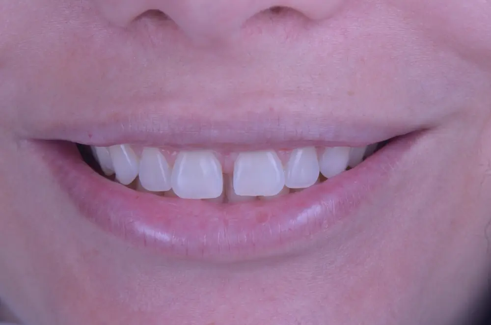 Fechamento de Diastema com Facetas em Resina Composta em Recife — antes do tratamento