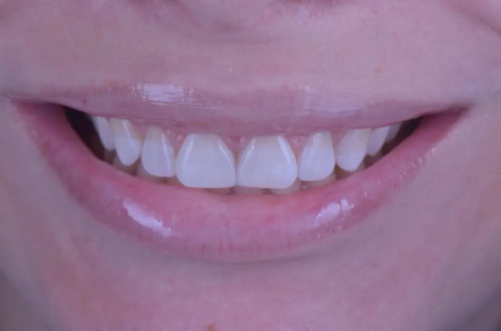 Fechamento de Diastema com Facetas em Resina Composta em Recife — depois (Dra. Natália Pompílio)