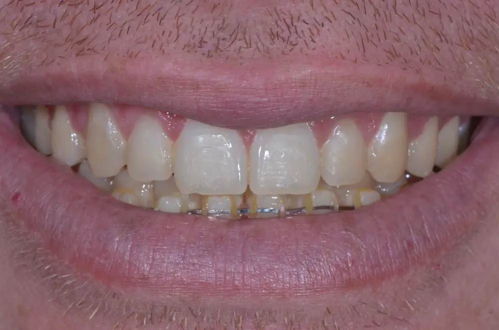 Harmonização do Sorriso com Facetas em Resina + Contorno em Recife — antes do tratamento